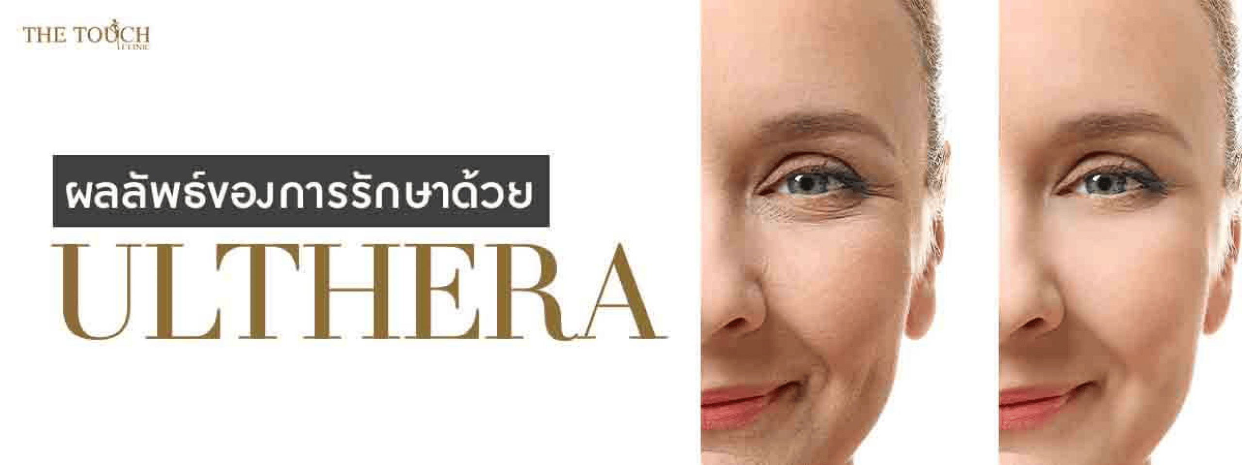 ulthera-banner-2@2x