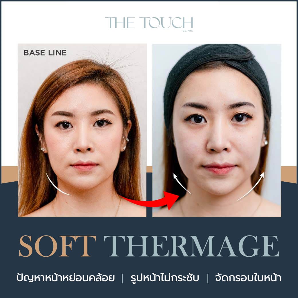 Review-Soft-Thermage-1