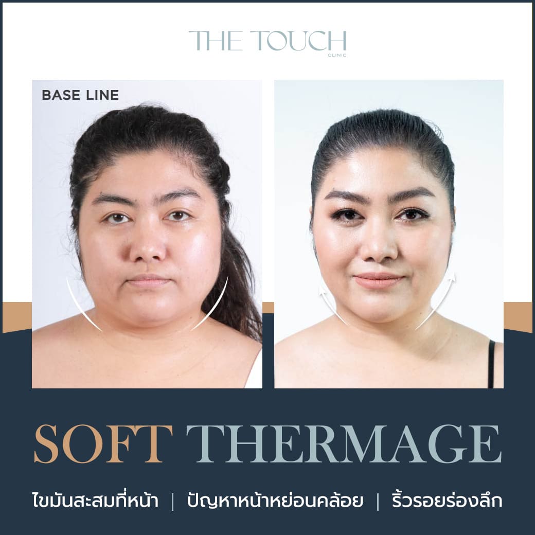 Review-Template-Soft-Thermage-2