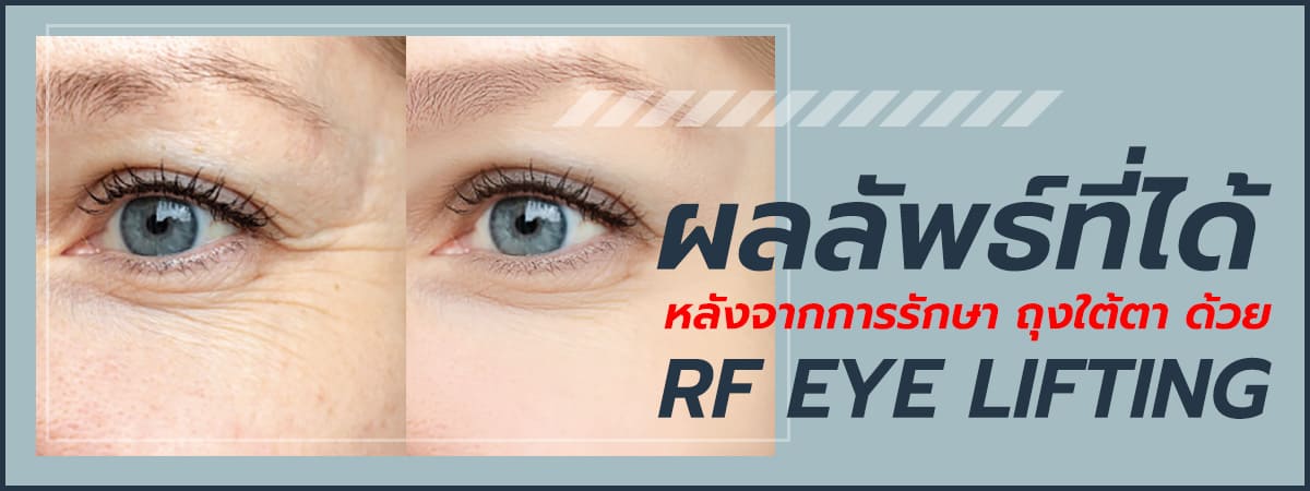 ผลลัพธ์ที่ได้หลังจากการรักษาถุงใต้ตา-ด้วย-RF-Eye-Lifting-1